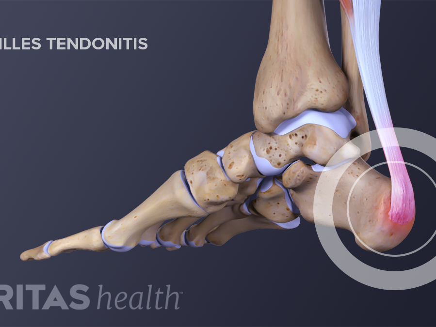 How to get rid of Achilles pain