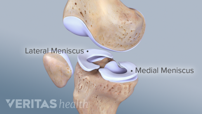 So you tore your meniscus