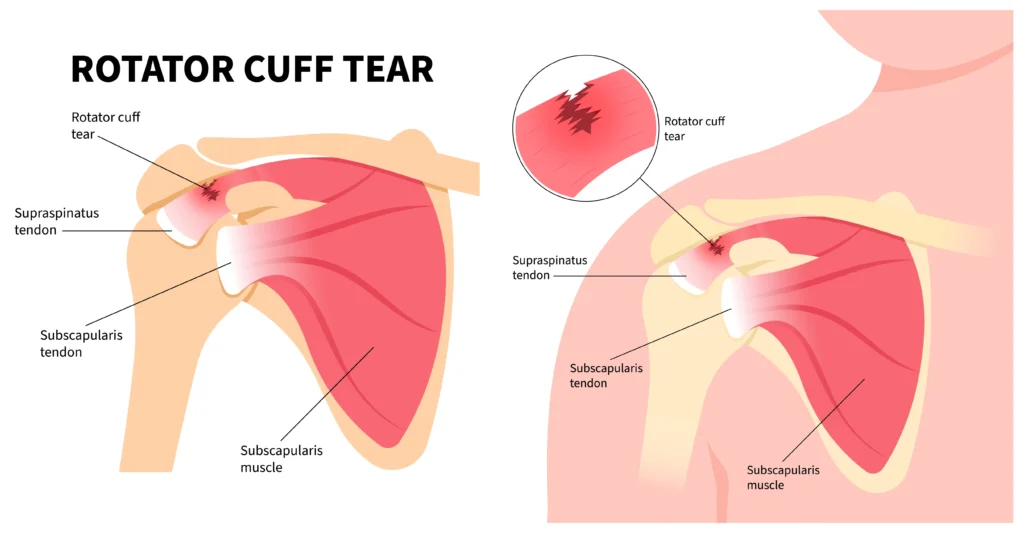 diagram showing where the subscapularis muscle and supraspinatus tendon connect to the bone and how a tear in the tendon causes a rotator cuff injury